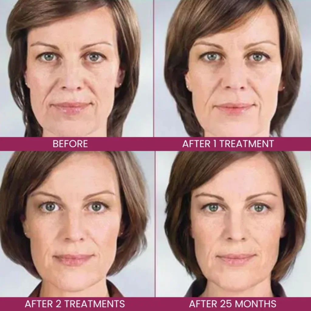 Before and After Sculptra treatment results at Venus Rising Med Spa in Vancouver, WA