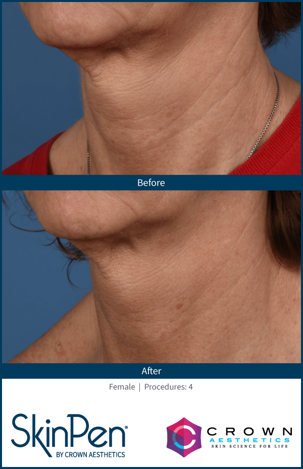 Before and After Neck 4