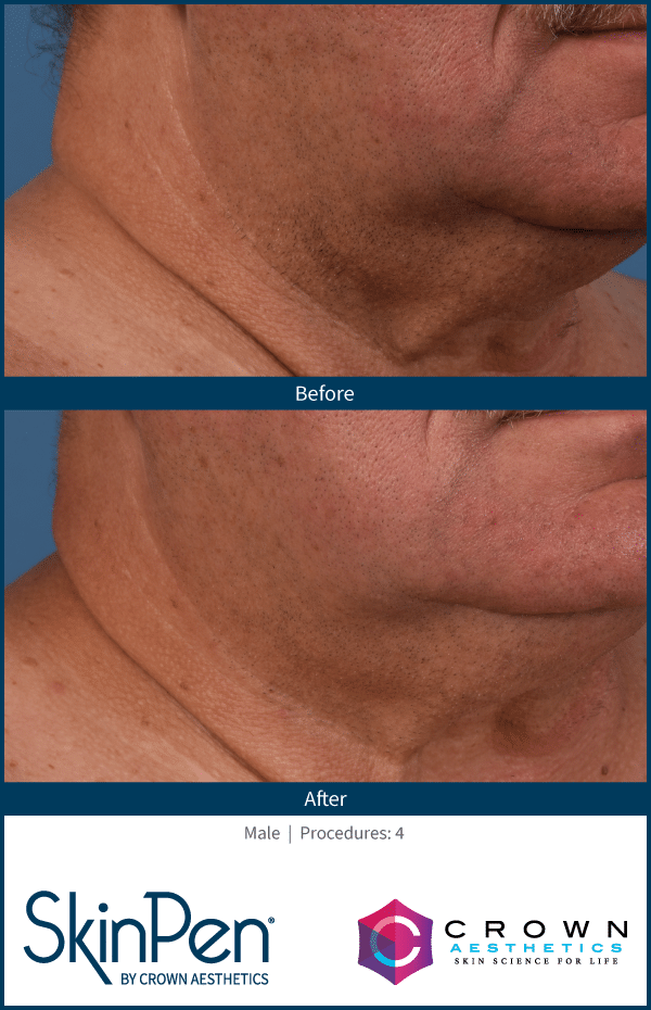 Before and After Neck 5