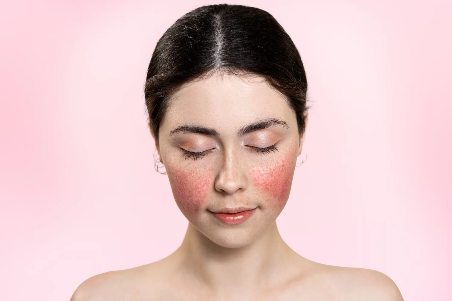 Acne Program in Vancouver, WA, at Venus Rising Med Spa