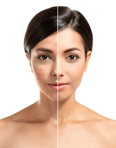 Acne Program in Vancouver, WA by Venus Rising Med Spa LLC